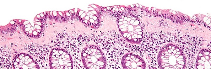 Kolagenowe zapalenie jelita grubego