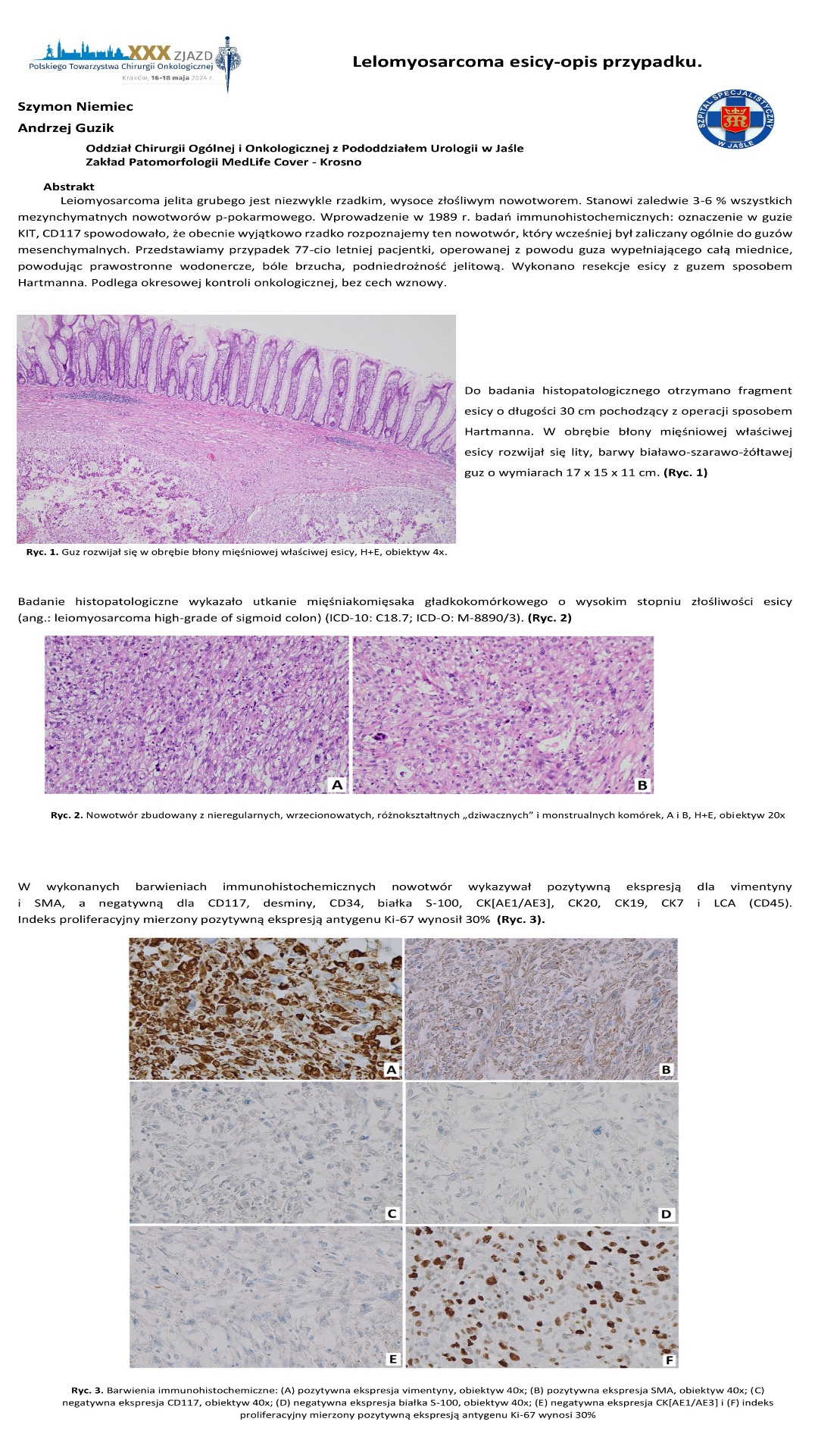 Leiomyosarcoma high-grade of sigmoid colon - opis przypadku