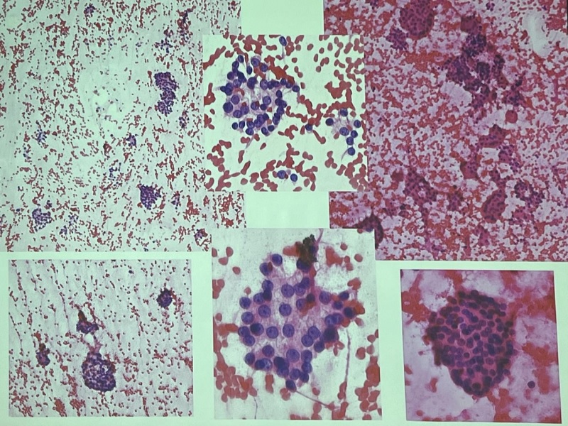 Cytologia tarczycy