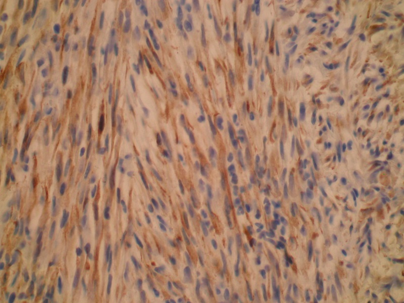 Pooperacyjny guzek z wrzecionowatych komórek (ang.: postoperative spindle cell nodule) pęcherza moczowego